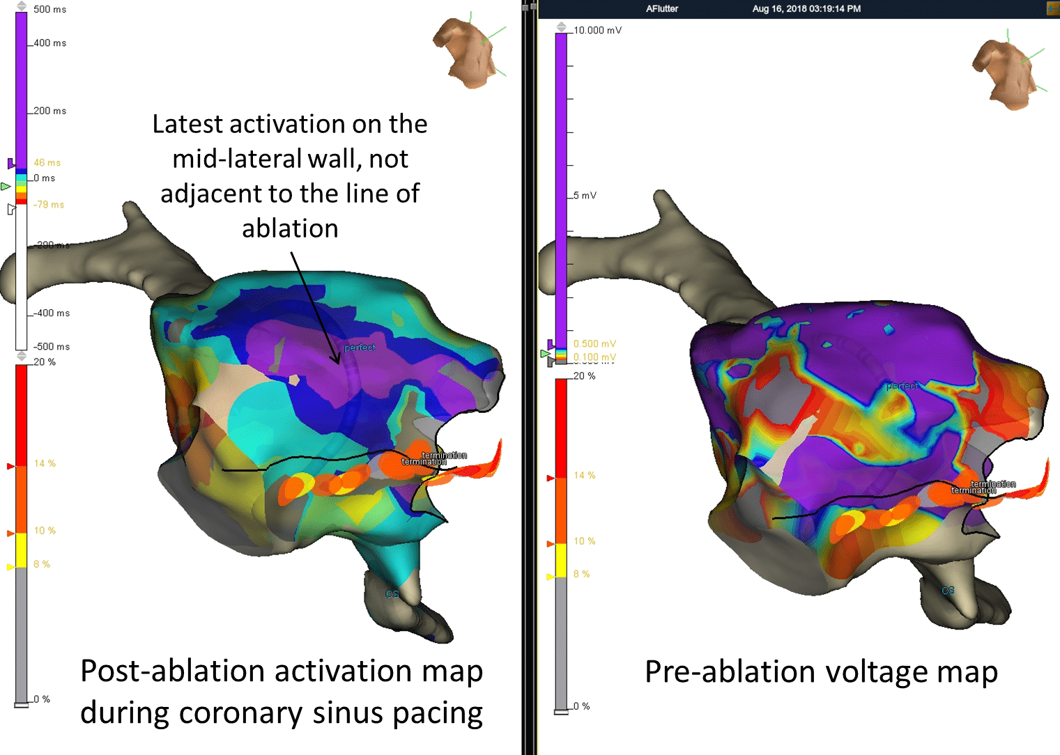 Misleading activation map corresponding with low voltage areas